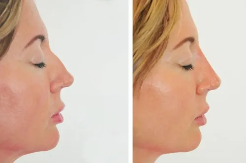 هر آنچه پیش از تزریق فیلر بینی باید بدانید